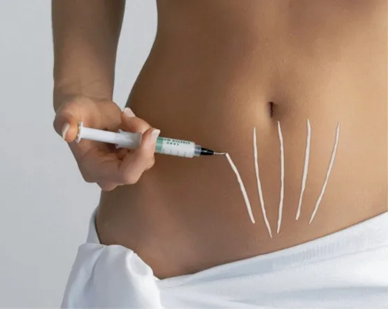 სტრიები, როგორ, მოვიშოროთ, პროფილაქტიკა