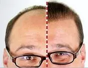 თმის, გადანერგვა, მეთოდები, სიმართლე, შედარება, FUT, STRIP, FUE, HFE 