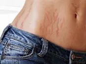 სტრიები, როგორ, მოვიშოროთ, ფეხმძიმობა,პროფილაქტიკა, მიზეზები