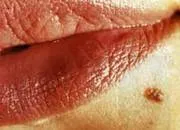 მეჭეჭები