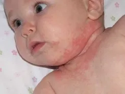 რა არის ნასიცხი