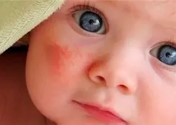 ნასიცხი ახალშობილის სახეზე