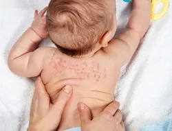 ნასიცხის სიმტომები