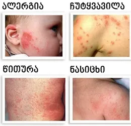 როგორ გავარჩიოთ ნასიცხი ალერგიისგან