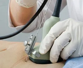 ფეხმძიმობის მე-16 კვირა - ამნიოცენტეზი